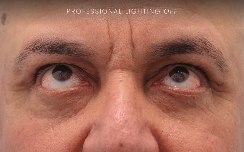Winged Blepharoplasty Before & After Gallery - Patient 401906 - Image 6