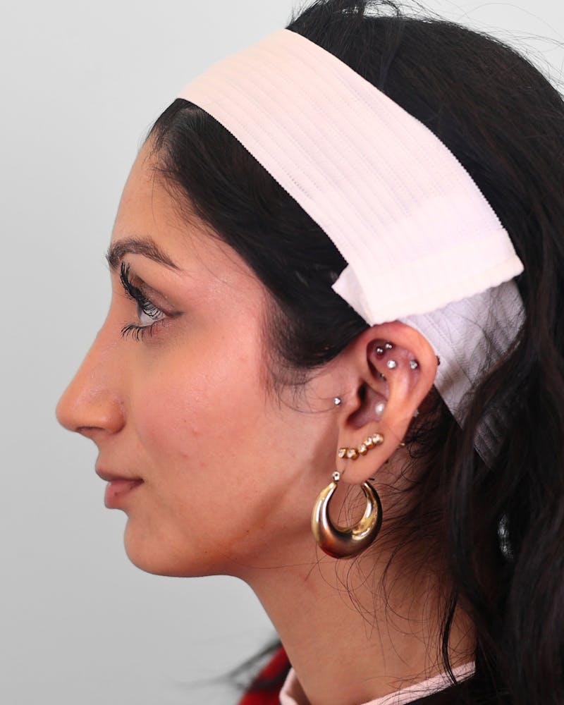 Rhinoplasty Before & After Gallery - Patient 172381 - Image 6