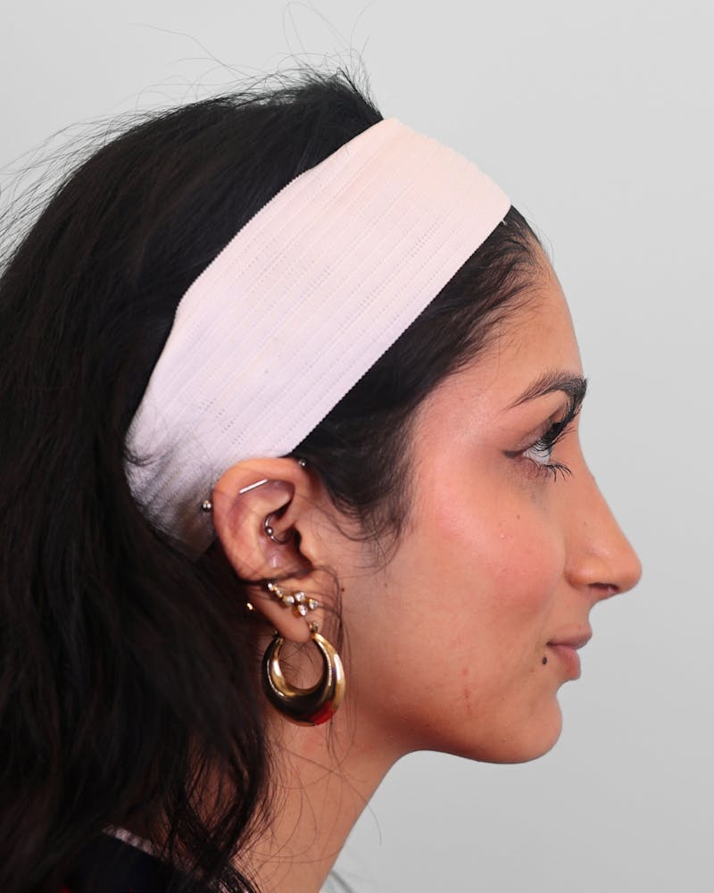 Rhinoplasty Before & After Gallery - Patient 172381 - Image 2