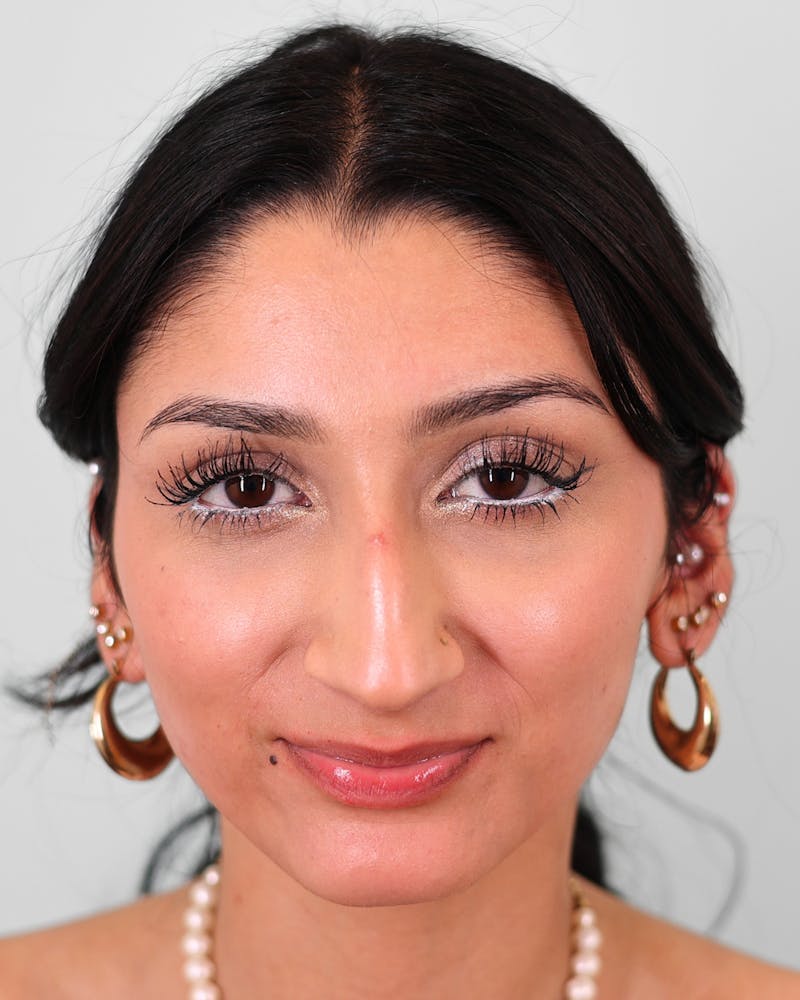 Rhinoplasty Before & After Gallery - Patient 172381 - Image 3