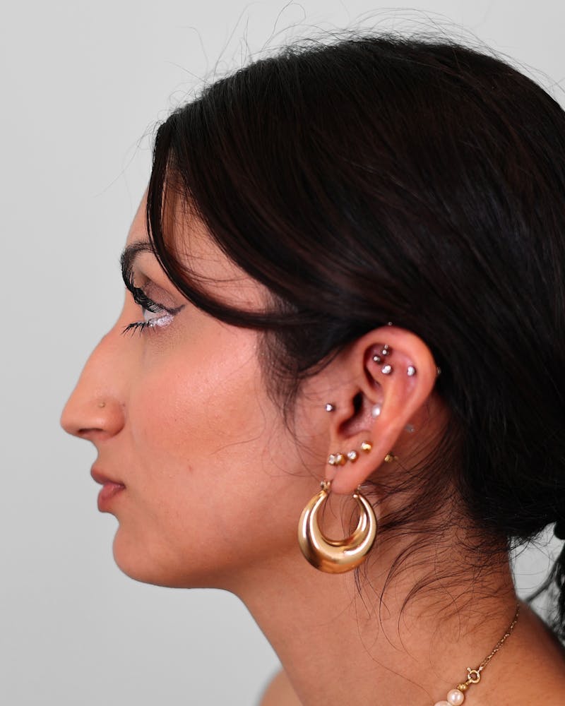 Rhinoplasty Before & After Gallery - Patient 172381 - Image 5