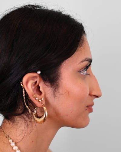 Rhinoplasty Before & After Gallery - Patient 172381 - Image 1