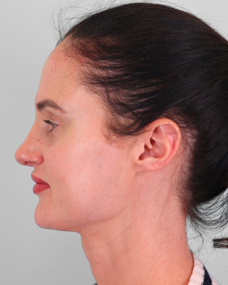 Rhinoplasty Before & After Gallery - Patient 189340 - Image 6