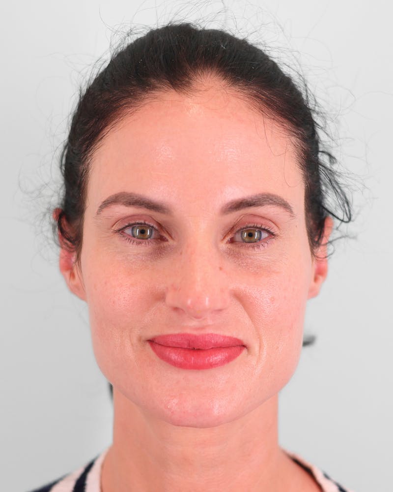 Rhinoplasty Before & After Gallery - Patient 189340 - Image 4