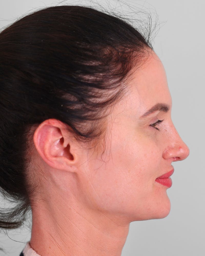 Rhinoplasty Before & After Gallery - Patient 189340 - Image 2