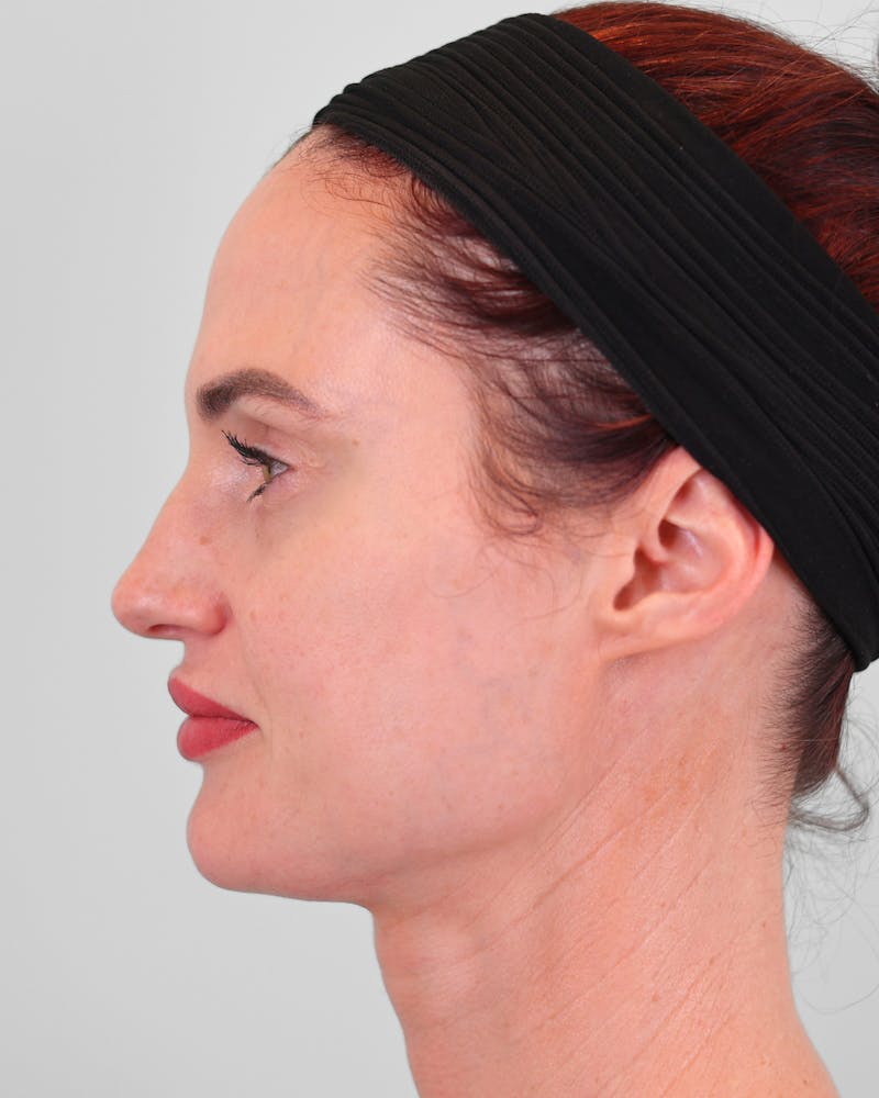 Rhinoplasty Before & After Gallery - Patient 189340 - Image 5