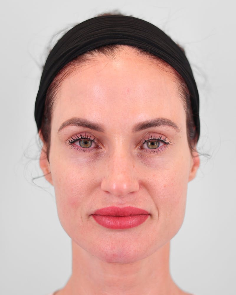 Rhinoplasty Before & After Gallery - Patient 189340 - Image 3