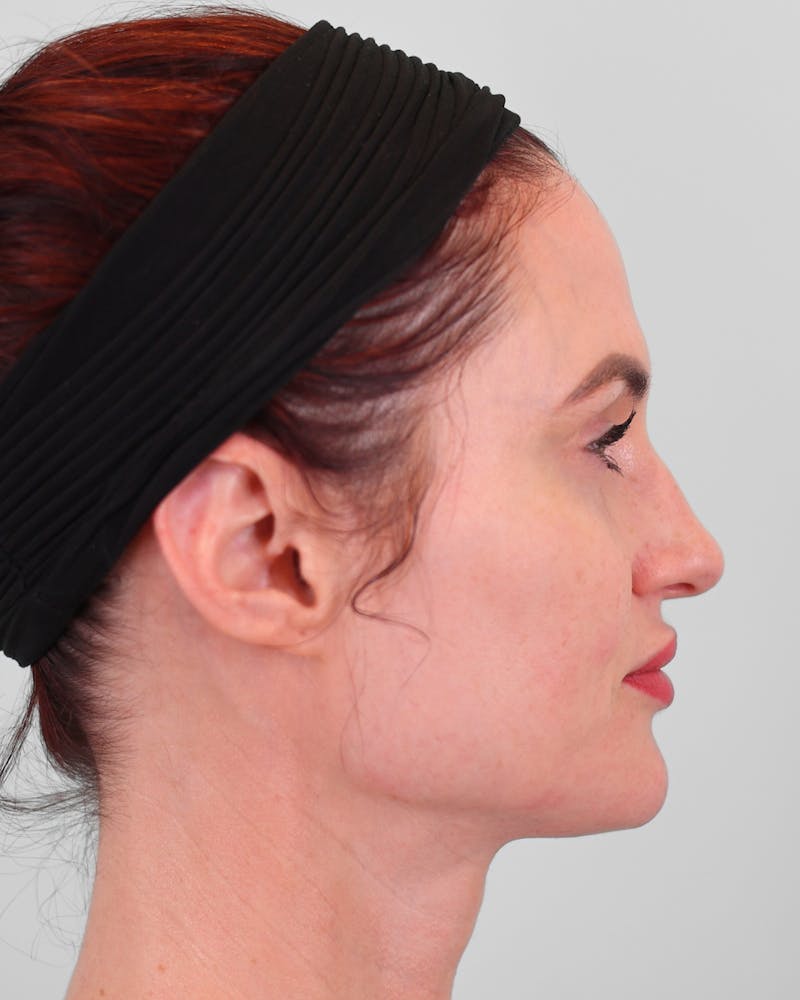 Rhinoplasty Before & After Gallery - Patient 189340 - Image 1
