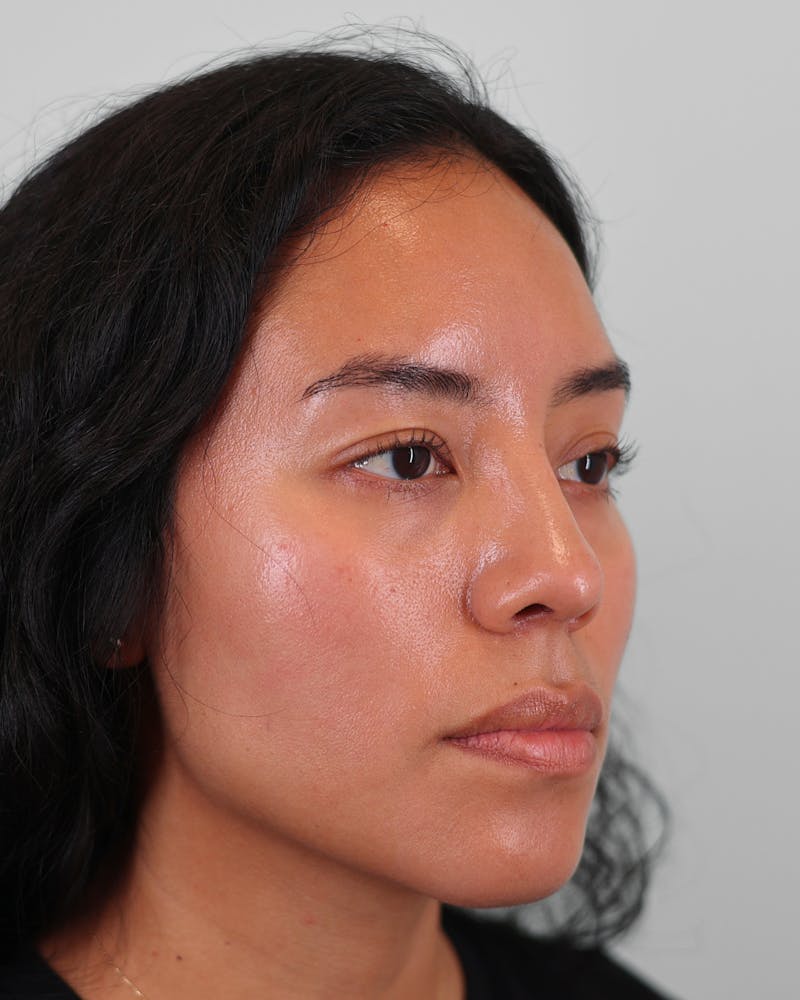 Rhinoplasty Before & After Gallery - Patient 408868 - Image 4