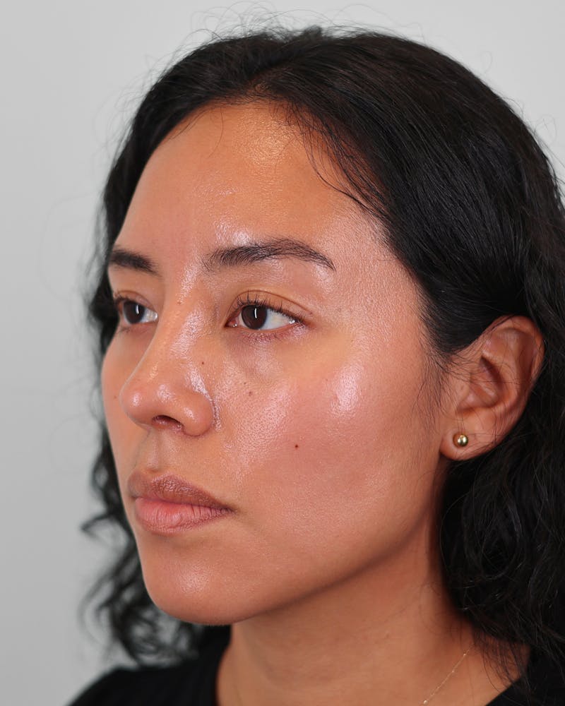 Rhinoplasty Before & After Gallery - Patient 408868 - Image 8