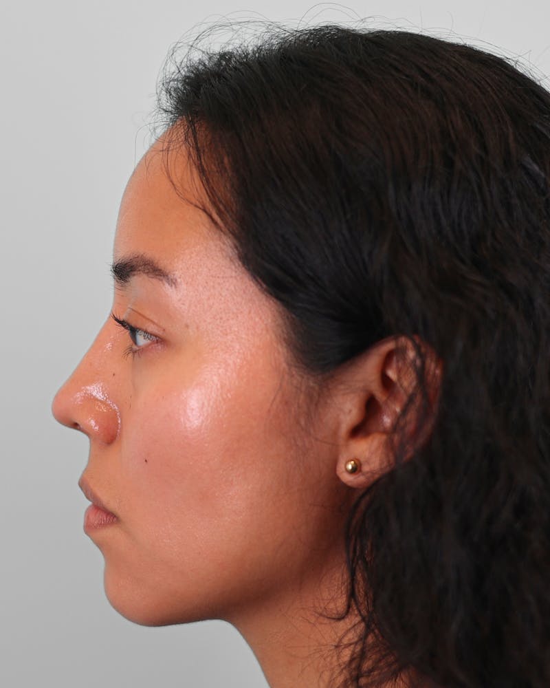 Rhinoplasty Before & After Gallery - Patient 408868 - Image 10