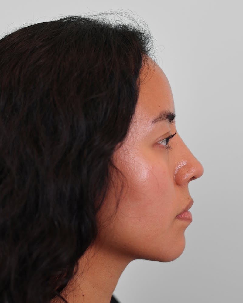 Rhinoplasty Before & After Gallery - Patient 408868 - Image 2