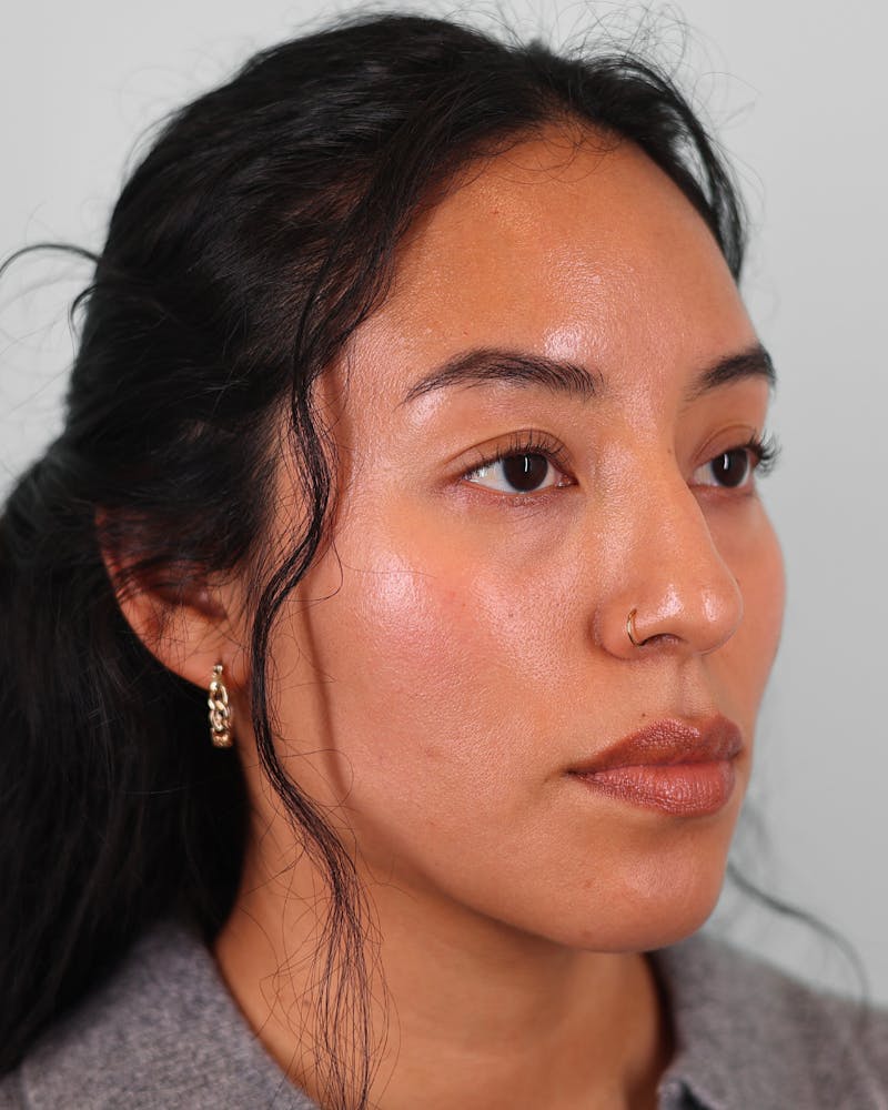 Rhinoplasty Before & After Gallery - Patient 408868 - Image 3