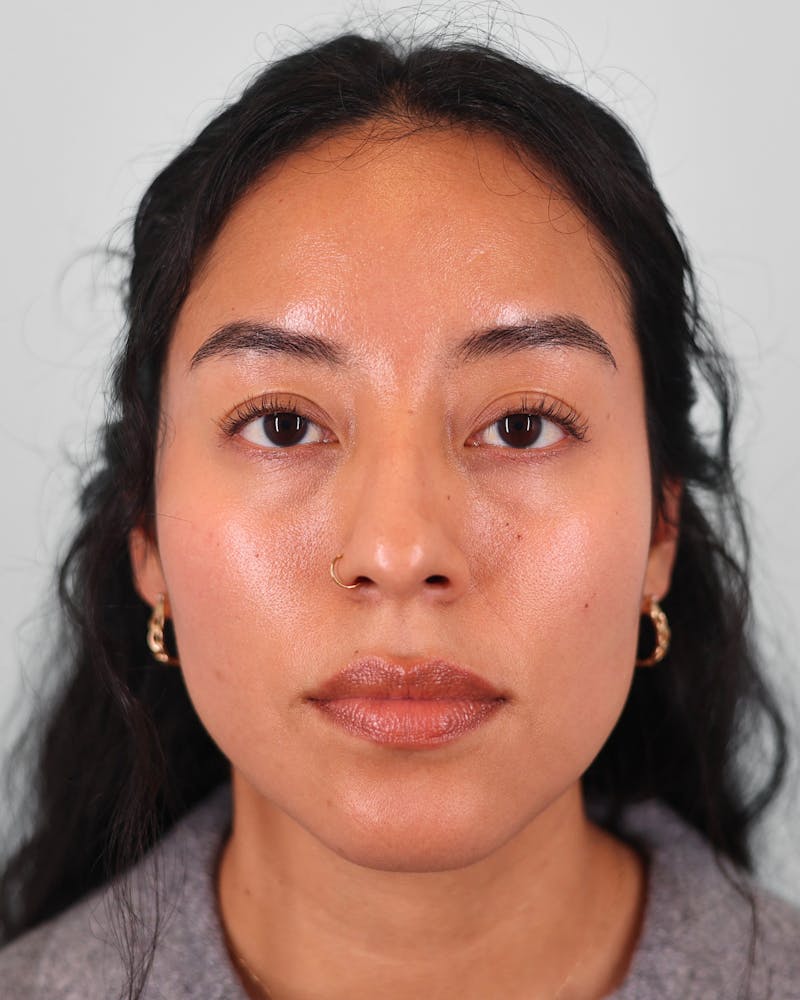 Rhinoplasty Before & After Gallery - Patient 408868 - Image 5