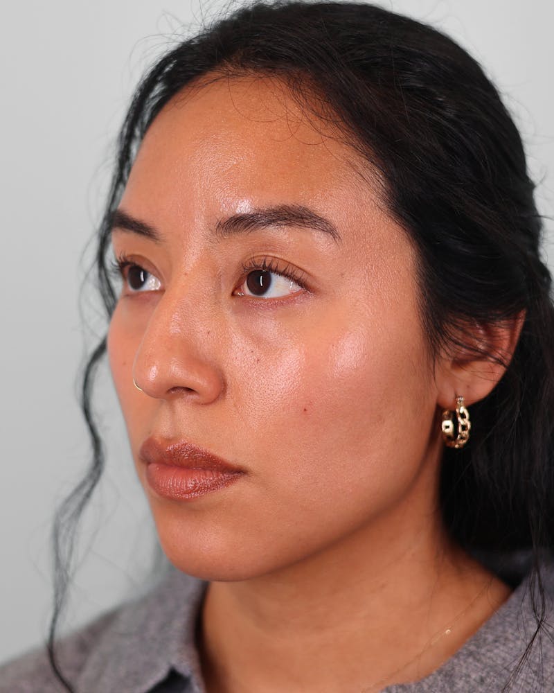 Rhinoplasty Before & After Gallery - Patient 408868 - Image 7