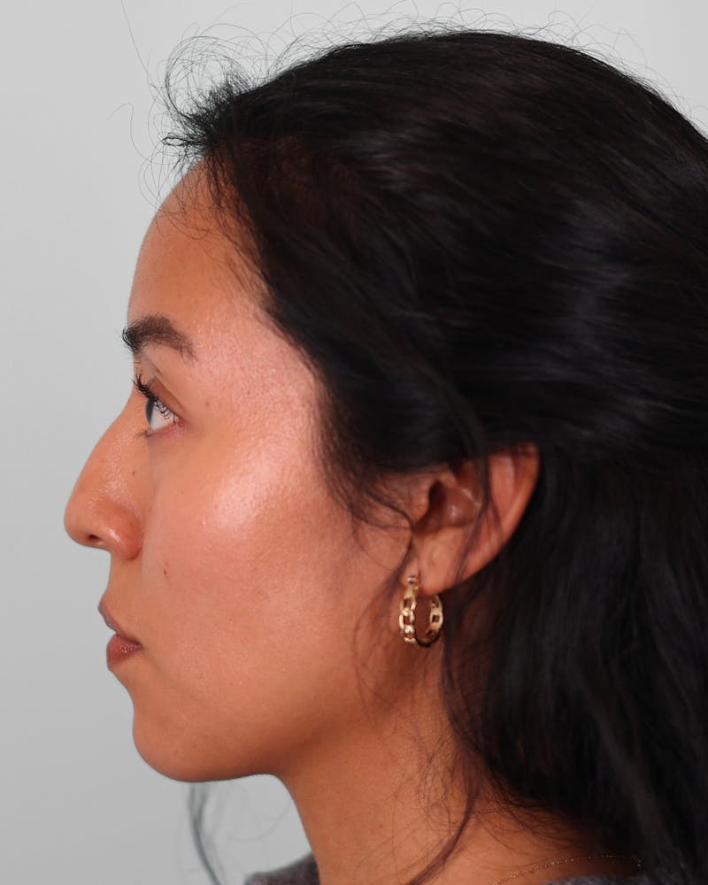 Rhinoplasty Before & After Gallery - Patient 408868 - Image 9
