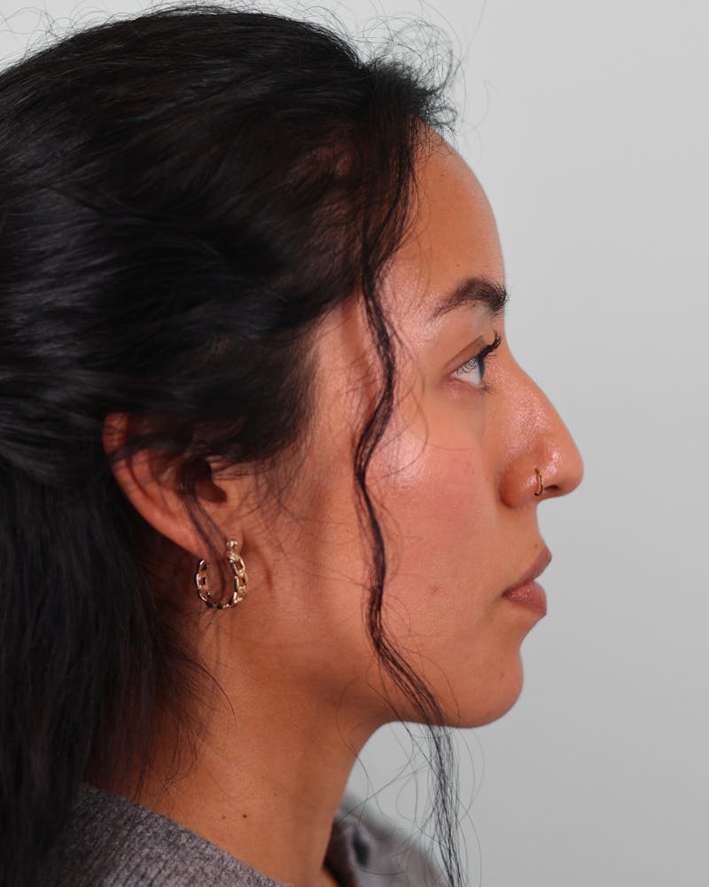 Rhinoplasty Before & After Gallery - Patient 408868 - Image 1