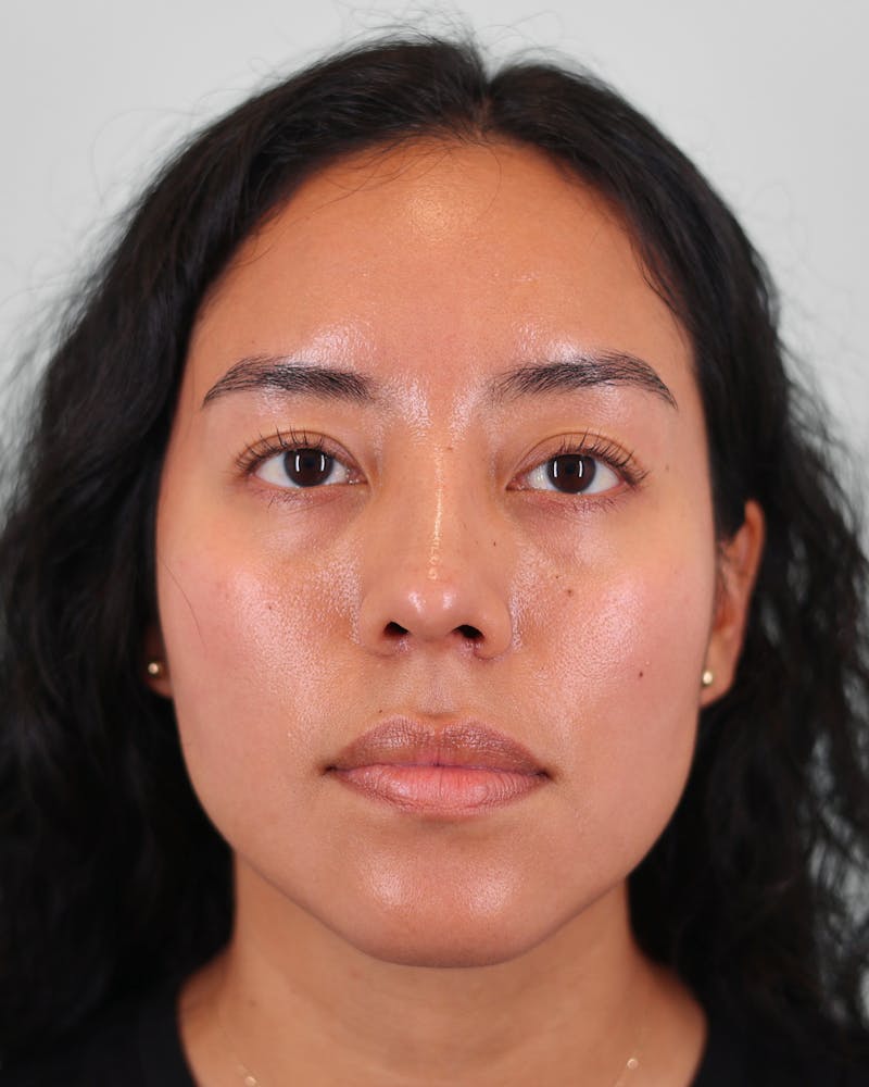 Rhinoplasty Before & After Gallery - Patient 408868 - Image 6