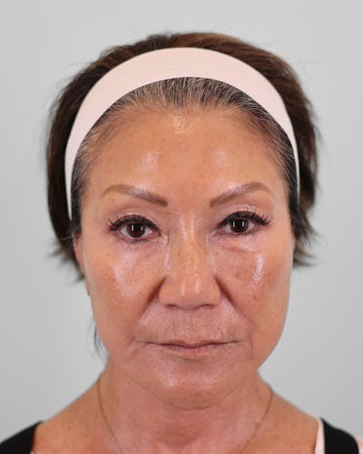 Neck Lift Before & After Gallery - Patient 684595 - Image 2