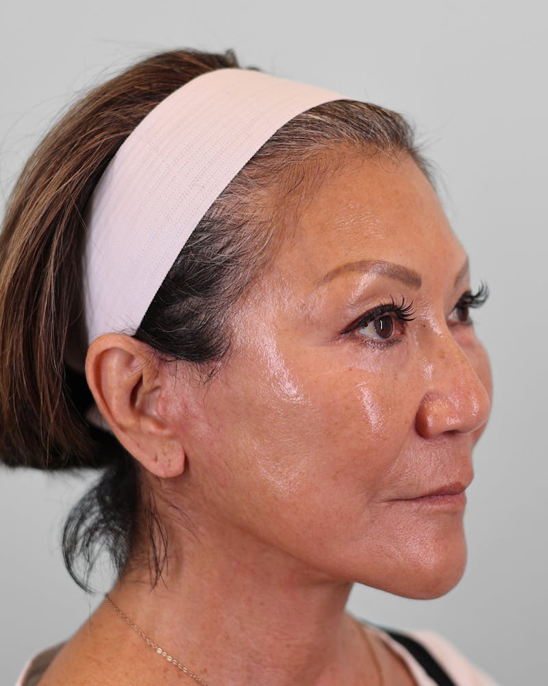 Chin Implant Before & After Gallery - Patient 373882 - Image 10