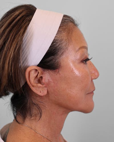 Chin Implant Before & After Gallery - Patient 373882 - Image 2