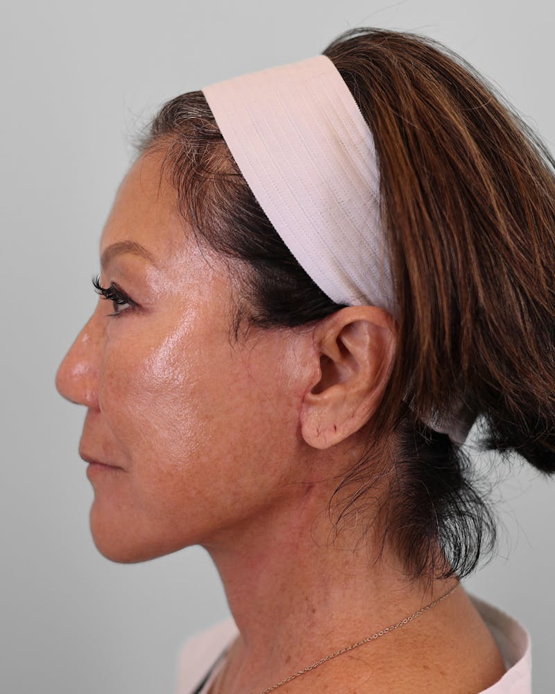 Chin Implant Before & After Gallery - Patient 373882 - Image 4