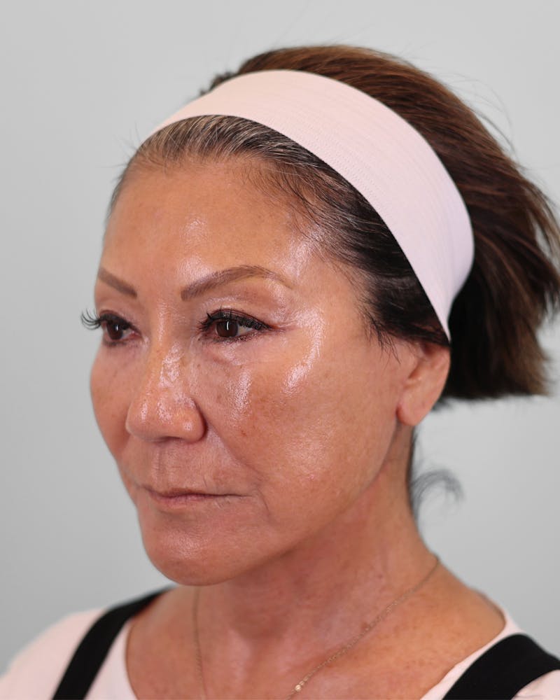 Chin Implant Before & After Gallery - Patient 373882 - Image 8