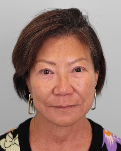 Neck Lift Before & After Gallery - Patient 684595 - Image 1