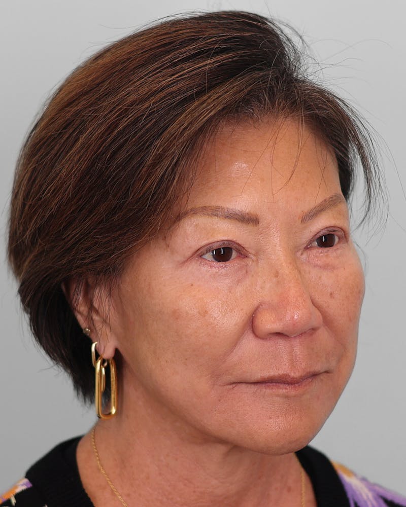 Chin Implant Before & After Gallery - Patient 373882 - Image 9