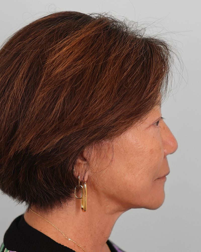 Chin Implant Before & After Gallery - Patient 373882 - Image 1