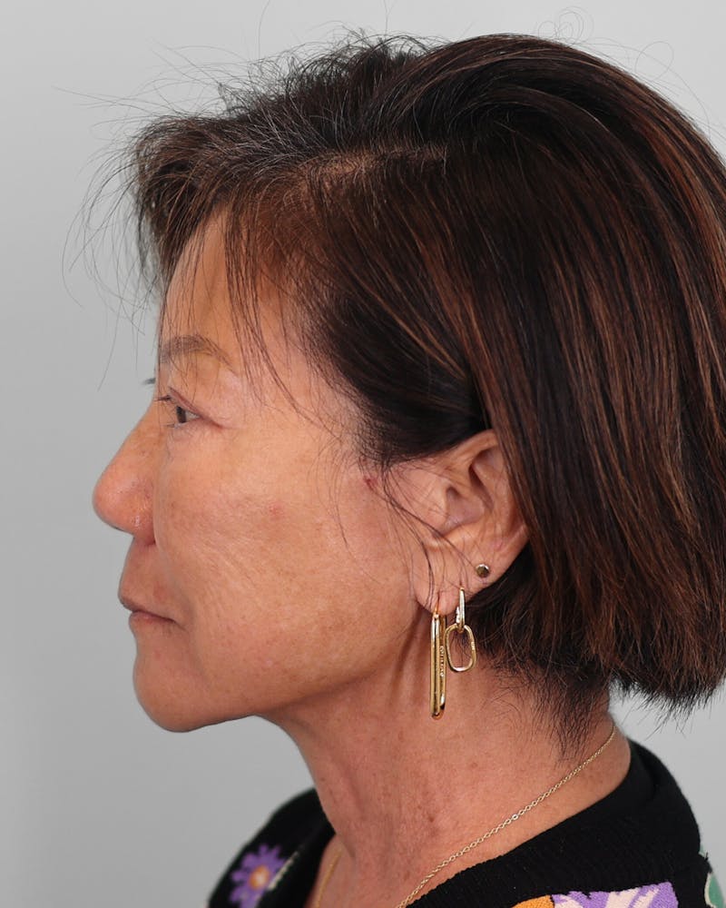 Chin Implant Before & After Gallery - Patient 373882 - Image 3