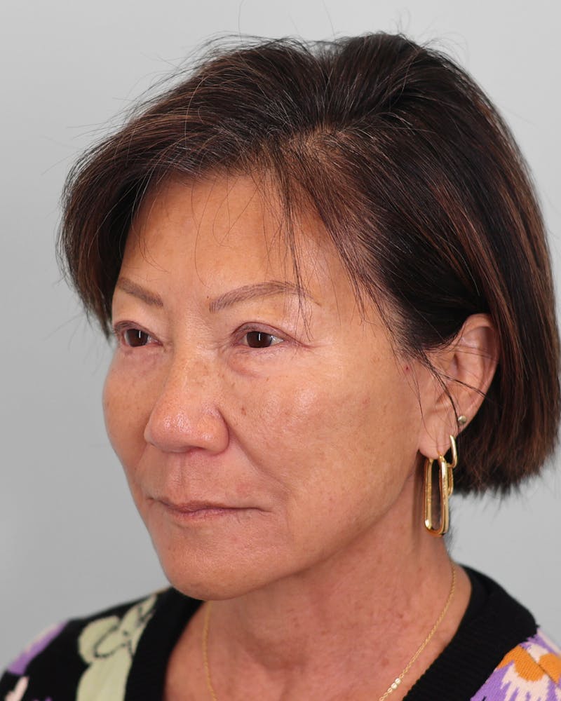 Chin Implant Before & After Gallery - Patient 373882 - Image 7