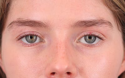 Brow Lift Before & After Gallery - Patient 242900 - Image 1