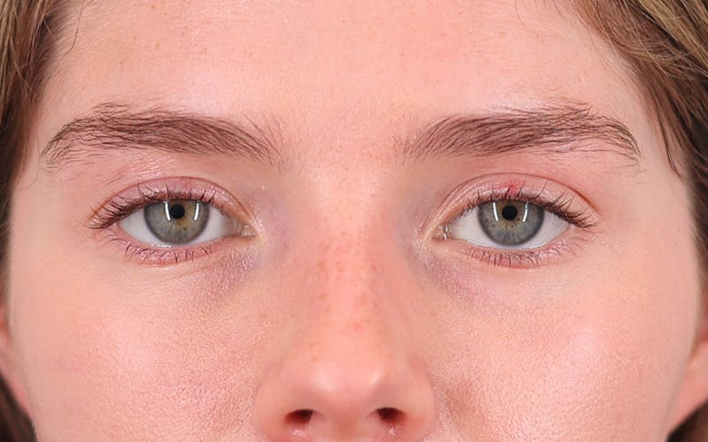 Winged Blepharoplasty Before & After Gallery - Patient 208994 - Image 1