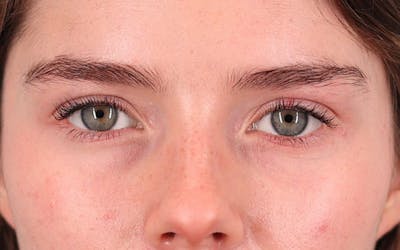 Brow Lift Before & After Gallery - Patient 242900 - Image 2