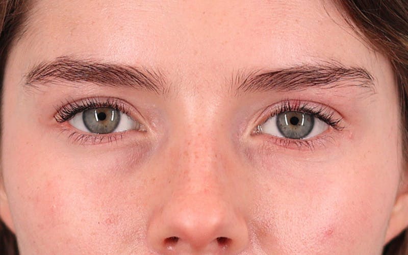 Winged Blepharoplasty Before & After Gallery - Patient 208994 - Image 2