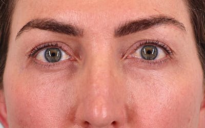 Brow Lift Before & After Gallery - Patient 335888 - Image 1