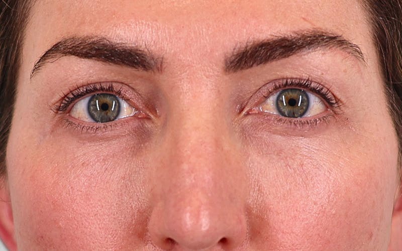 Winged Blepharoplasty Before & After Gallery - Patient 162791 - Image 1
