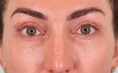 Brow Lift Before & After Gallery - Patient 335888 - Image 2