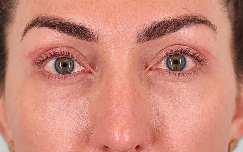 Winged Blepharoplasty Before & After Gallery - Patient 162791 - Image 2