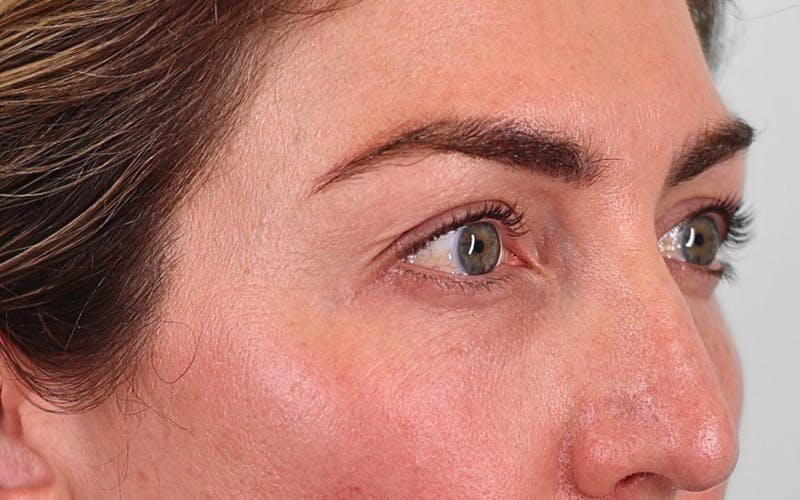 Winged Blepharoplasty Before & After Gallery - Patient 162791 - Image 3