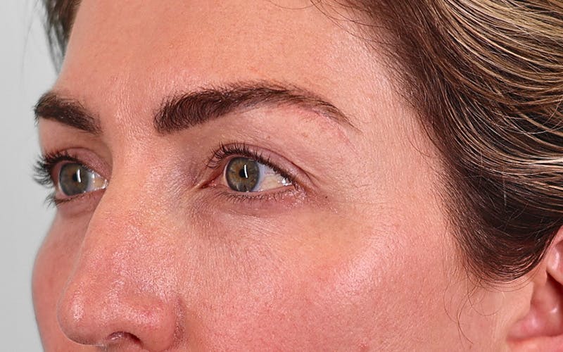 Winged Blepharoplasty Before & After Gallery - Patient 162791 - Image 5