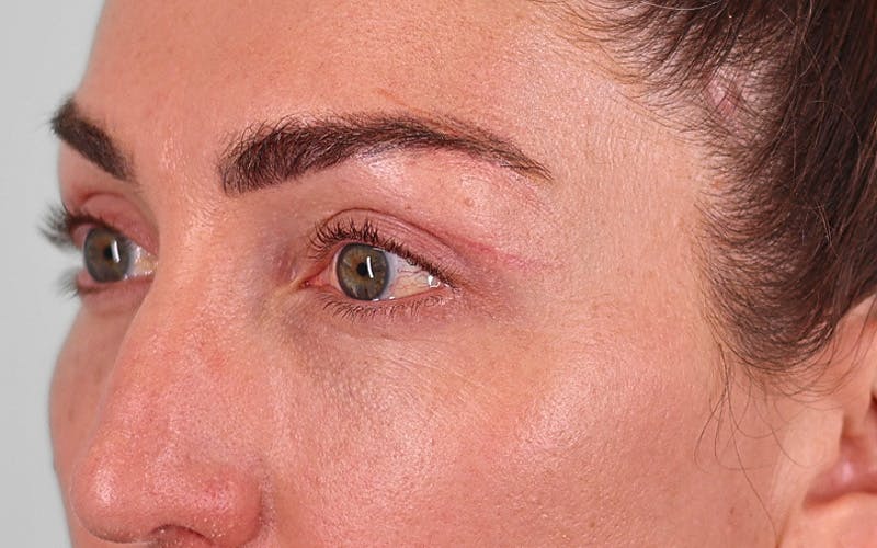 Winged Blepharoplasty Before & After Gallery - Patient 162791 - Image 6