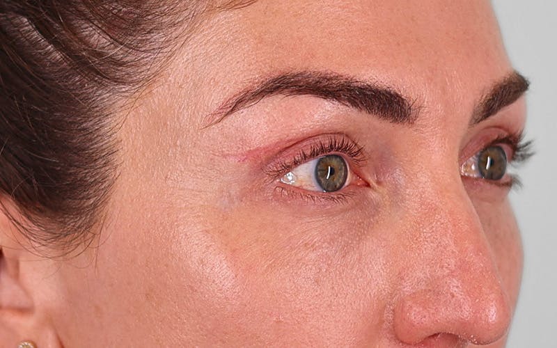 Winged Blepharoplasty Before & After Gallery - Patient 162791 - Image 4