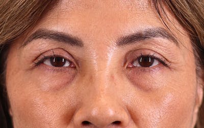 Brow Lift Before & After Gallery - Patient 459613 - Image 1