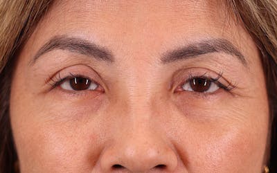 Brow Lift Before & After Gallery - Patient 459613 - Image 2