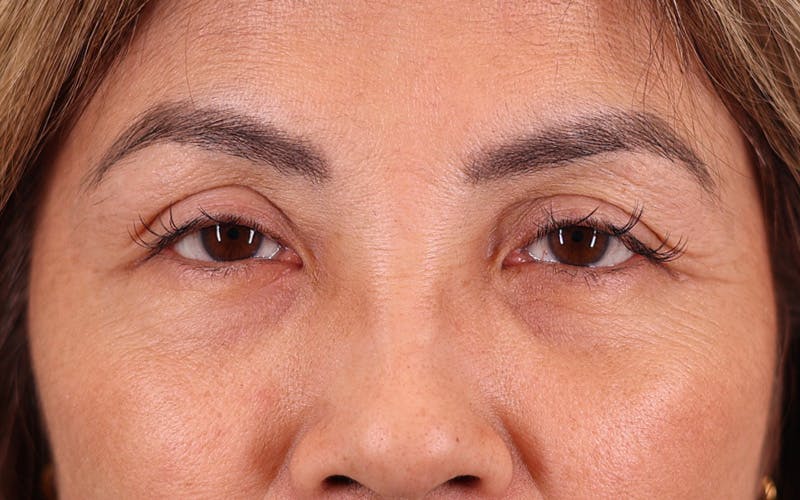 Lower Blepharoplasty Before & After Gallery - Patient 165906 - Image 2