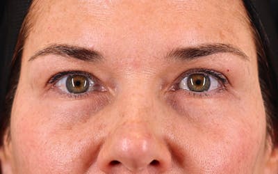 Brow Lift Before & After Gallery - Patient 873556 - Image 1