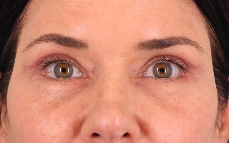 Lower Blepharoplasty Before & After Gallery - Patient 832647 - Image 2