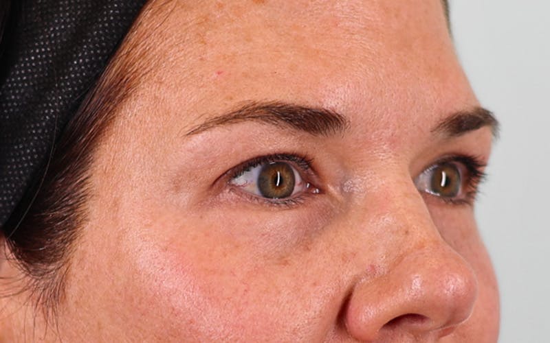 Lower Blepharoplasty Before & After Gallery - Patient 832647 - Image 3